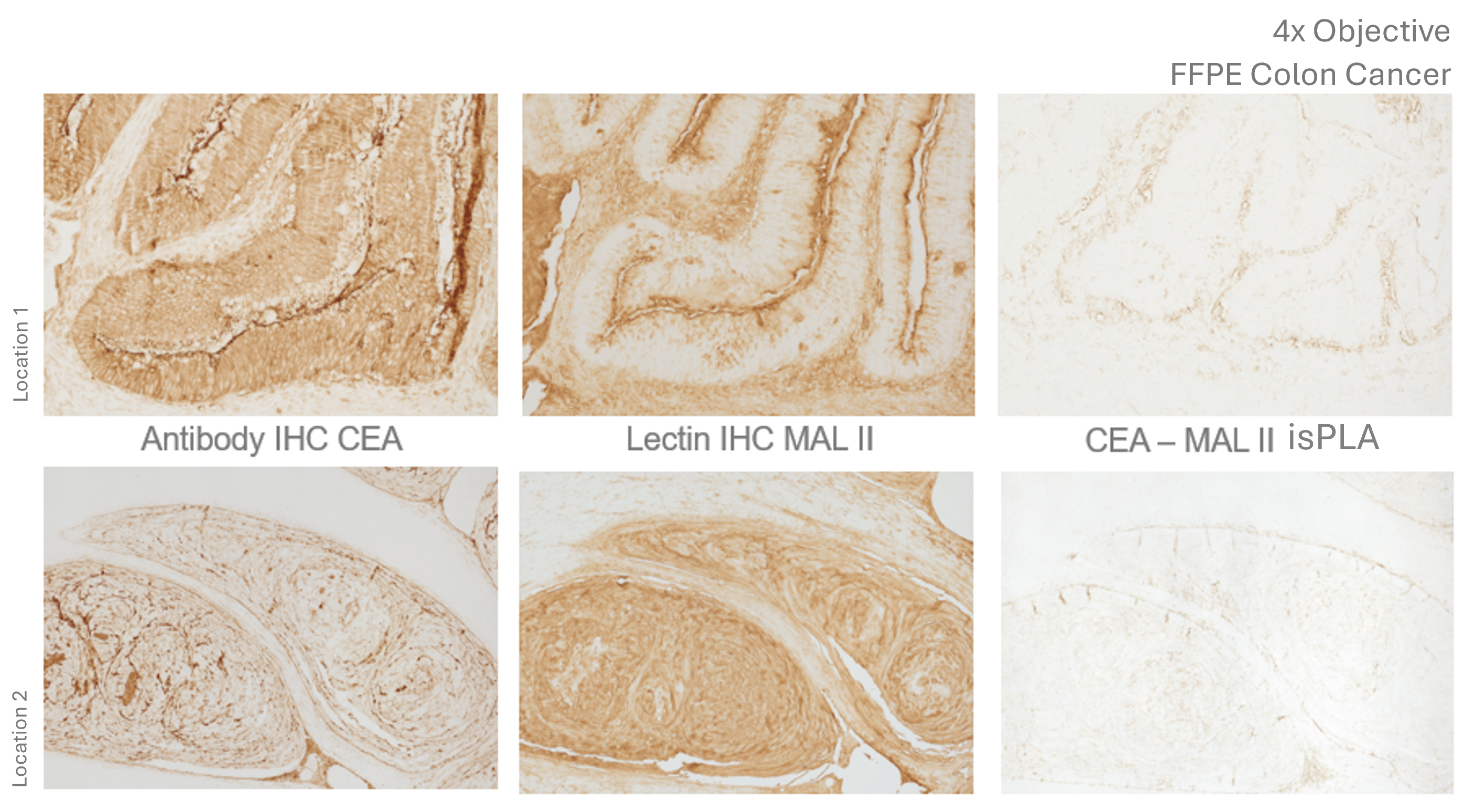 Colon Cancer CEA isPLA